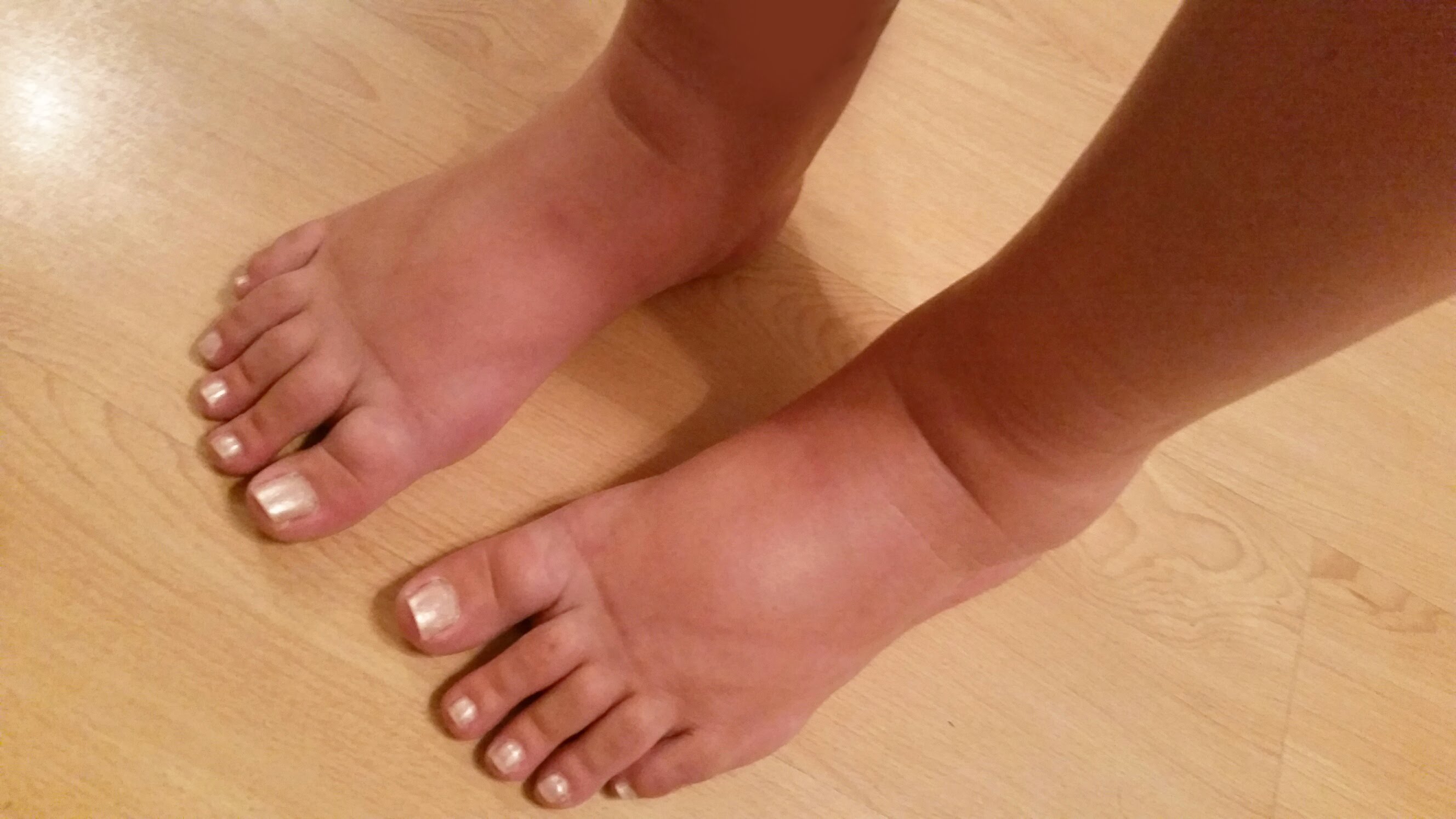 Swelling In Feet And Lower Legs 119