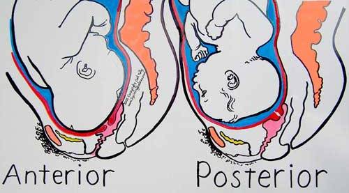 Baby in Posterior Position Births
