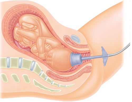 Forceps and Vacuum-Assisted Delivery