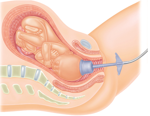 Forcep and Vacuum-Assisted Delivery